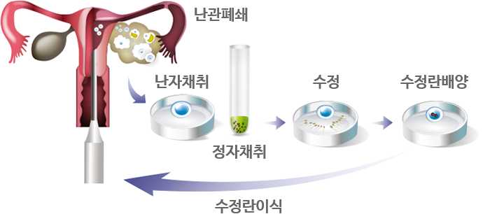 시험관아기 시술 | 차 여성의학연구소 대구 시험관아기 시술 | 차 여성의학연구소 대구